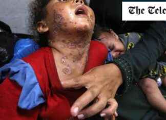 Skin Diseases Impacting Children in Gaza: Understanding and Prevention news-16082024-172157